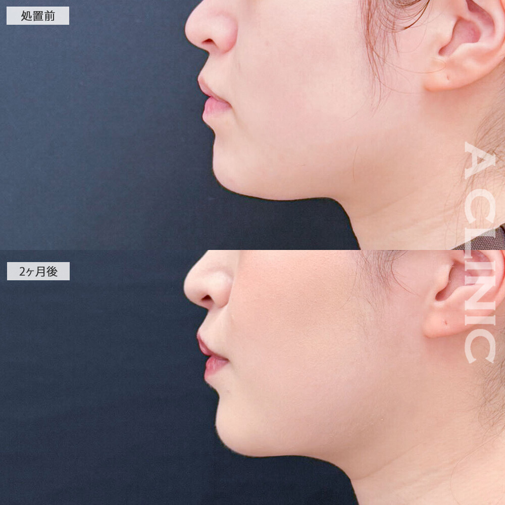 1day小顔脂肪吸引と小顔エラボトックスで女性らしい滑らかな輪郭に！処置前と2ヶ月後の症例です(20代女性)