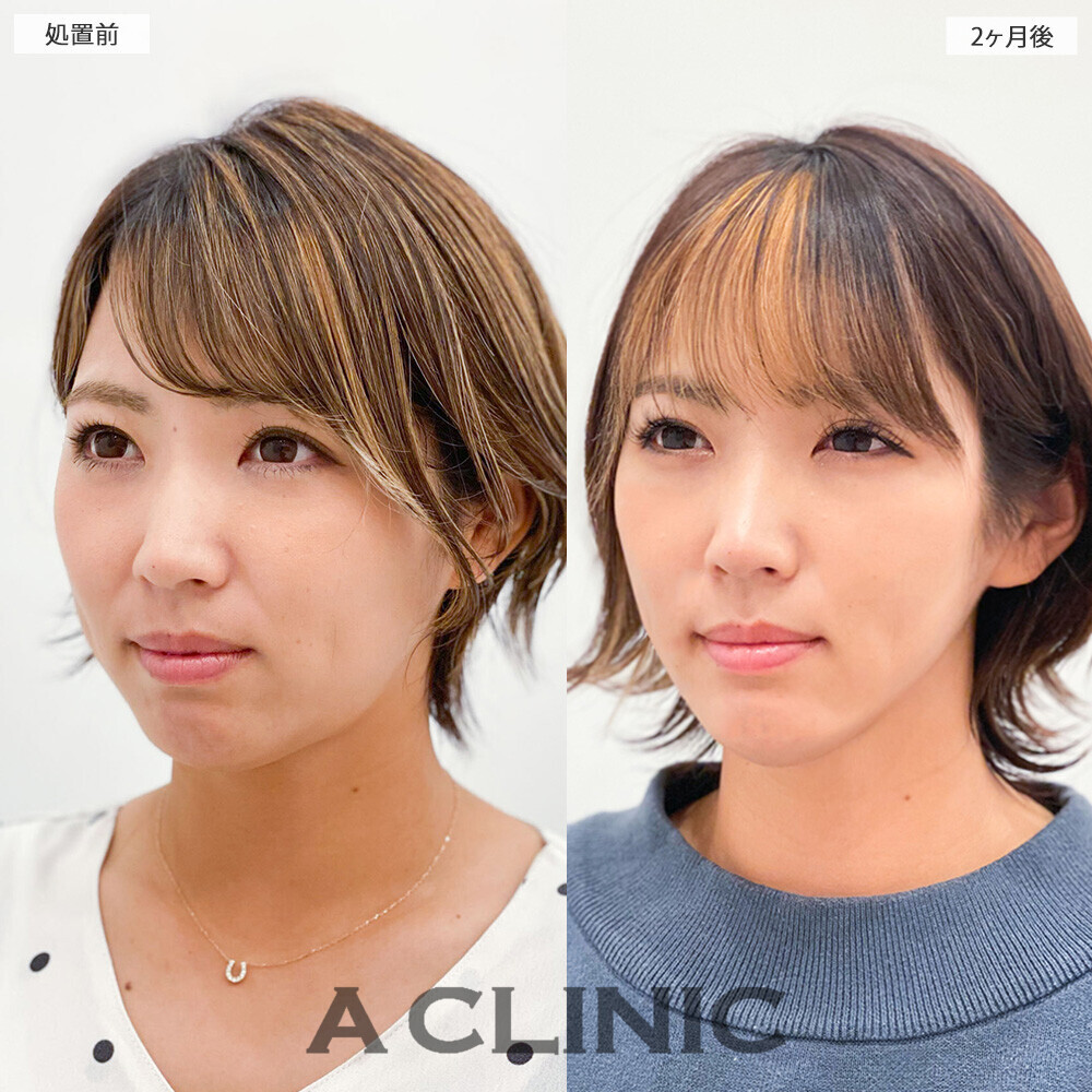 1day小顔脂肪吸引で重たく見えていた顔がスッキリ改善！こちら処置前から2ヶ月後の症例です(30代女性)