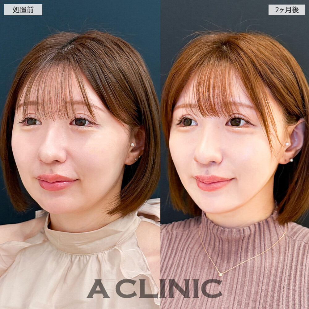 1day小顔脂肪吸引で余白がなくなり綺麗なVフェイスに！こちら処置前と2ヶ月後の症例です(30代女性)