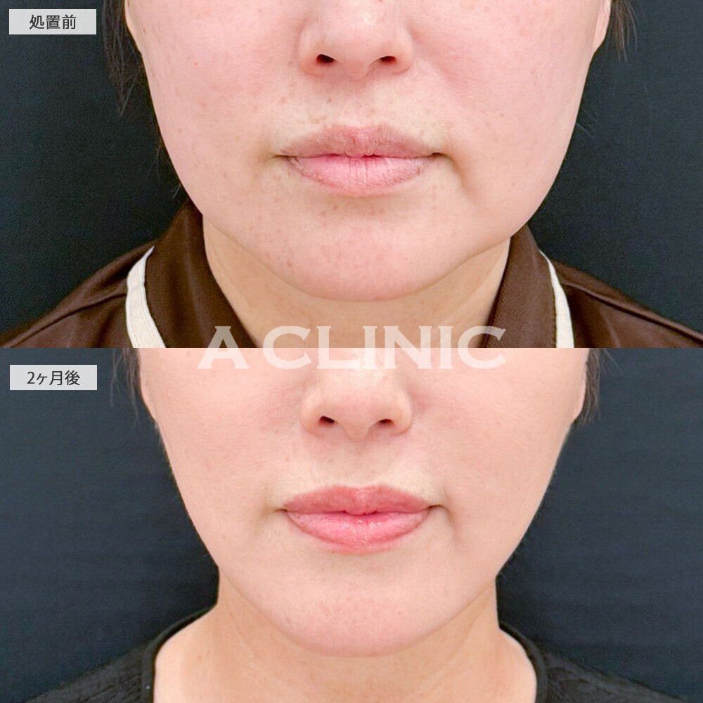 1day小顔脂肪吸引と注入処置の複合施術で脂肪もたるみもシワも全部解消！処置前と2ヶ月後の症例です(50代女性)