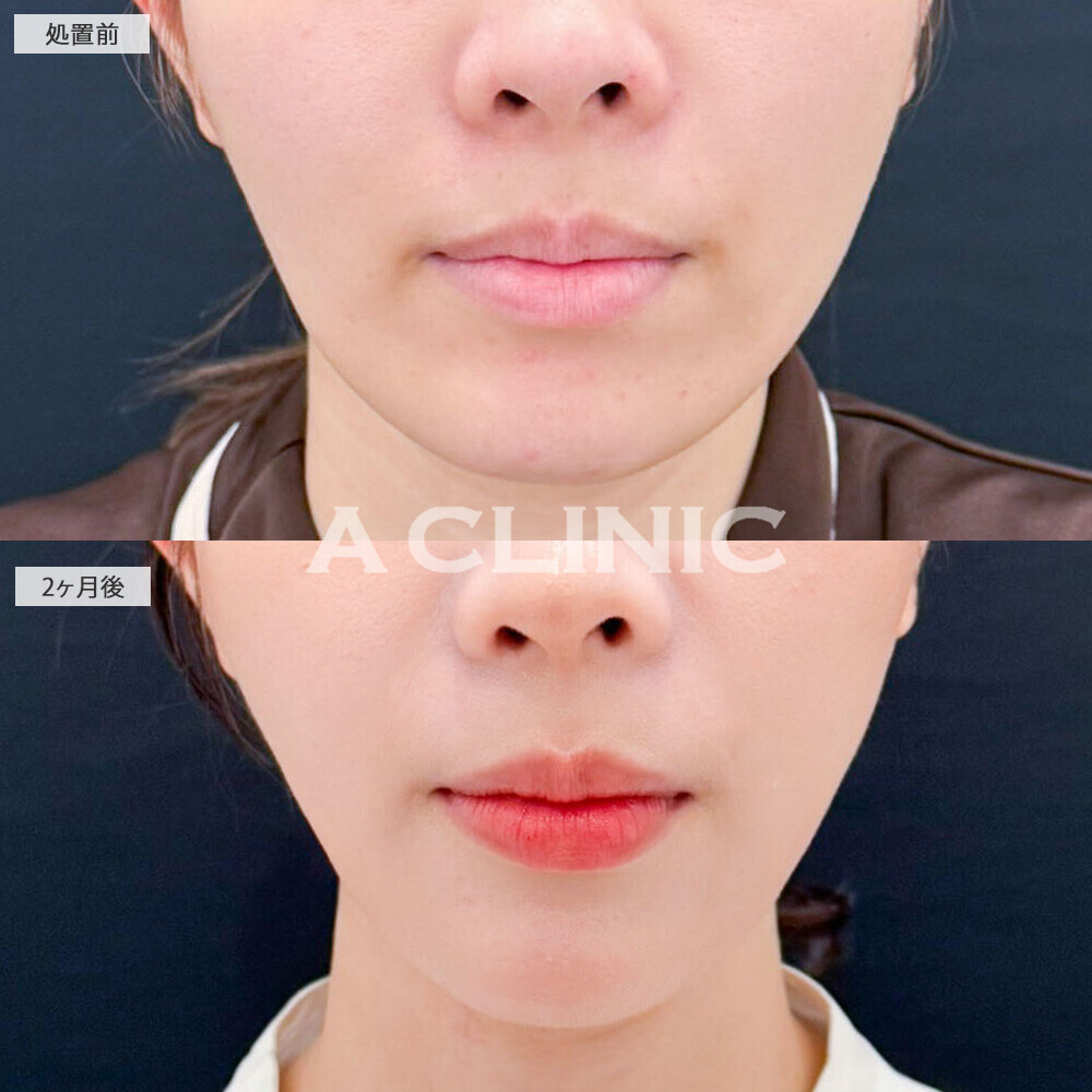 1day小顔脂肪吸引とボトックス注射(しわ)でクッキリ立体的な輪郭に！処置前から2ヶ月後の症例です(20代女性)