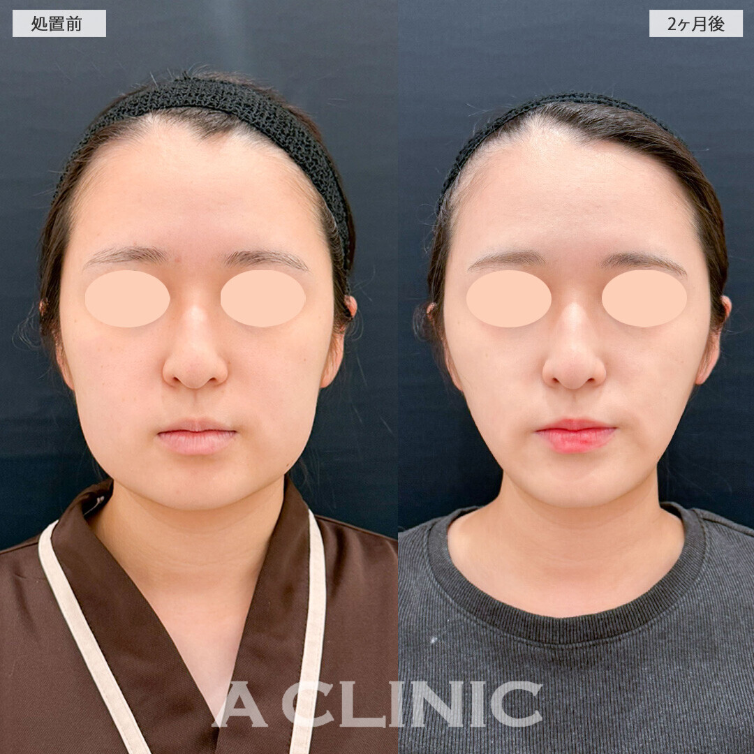 1day小顔脂肪吸引とバッカルファット除去術と小顔エラボトックスで頬のボリュームが激変！こちら処置前と2ヶ月後の症例です(20代女性)
