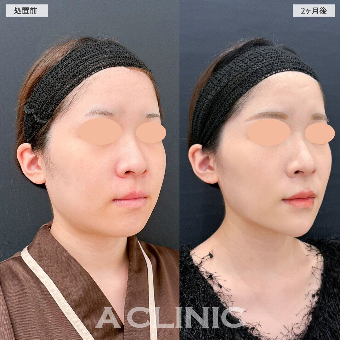 1day小顔脂肪吸引と小顔エラボトックスでどこから見てもしっかり小顔に！処置前と2ヶ月後の症例です(20代女性)