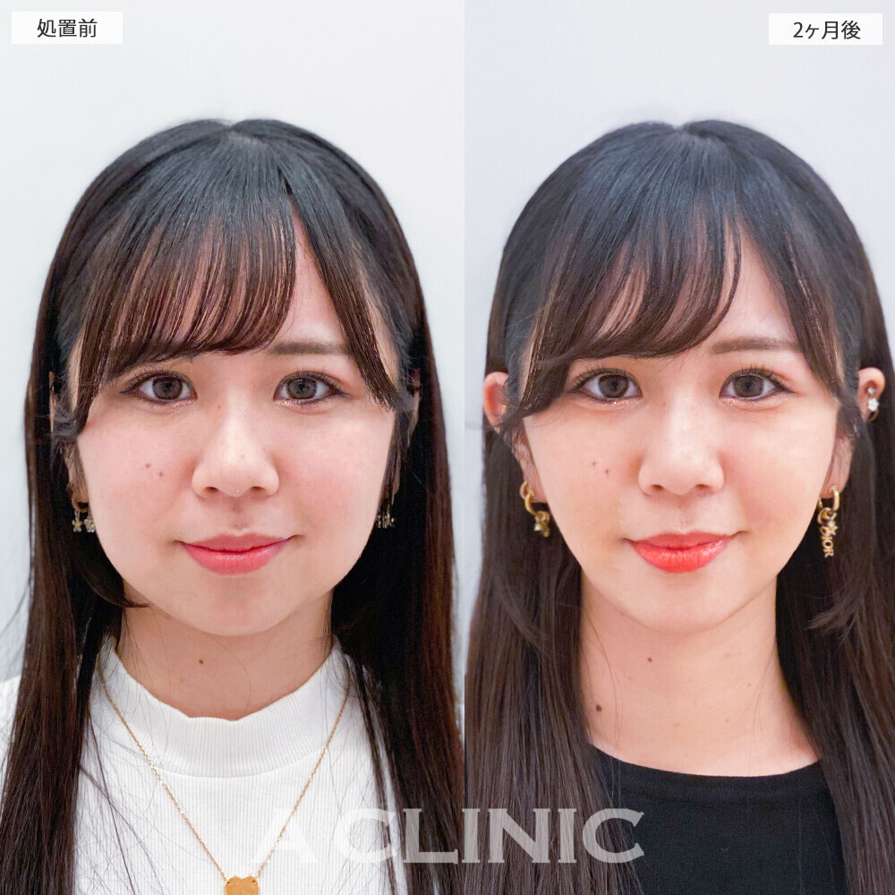1day小顔脂肪吸引で下膨れ顔が綺麗なVフェイスに！こちら処置前と2ヶ月後の症例です(20代女性)