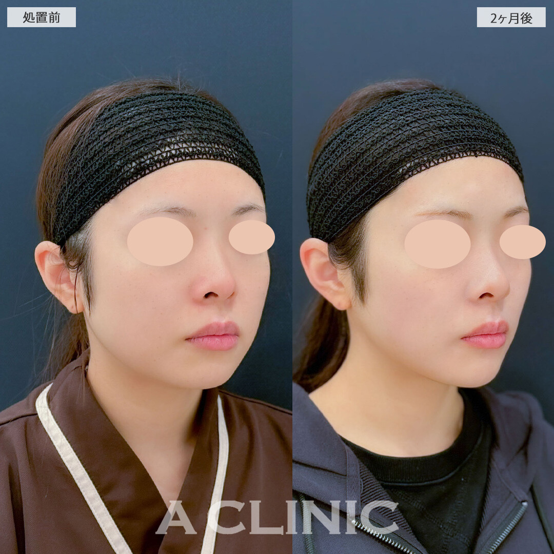 1day小顔脂肪吸引とバッカルファット除去術で気になる脂肪をしっかり除去しスッキリとしたフェイスラインになりました！こちら処置前と2ヶ月後の症例です(20代女性)