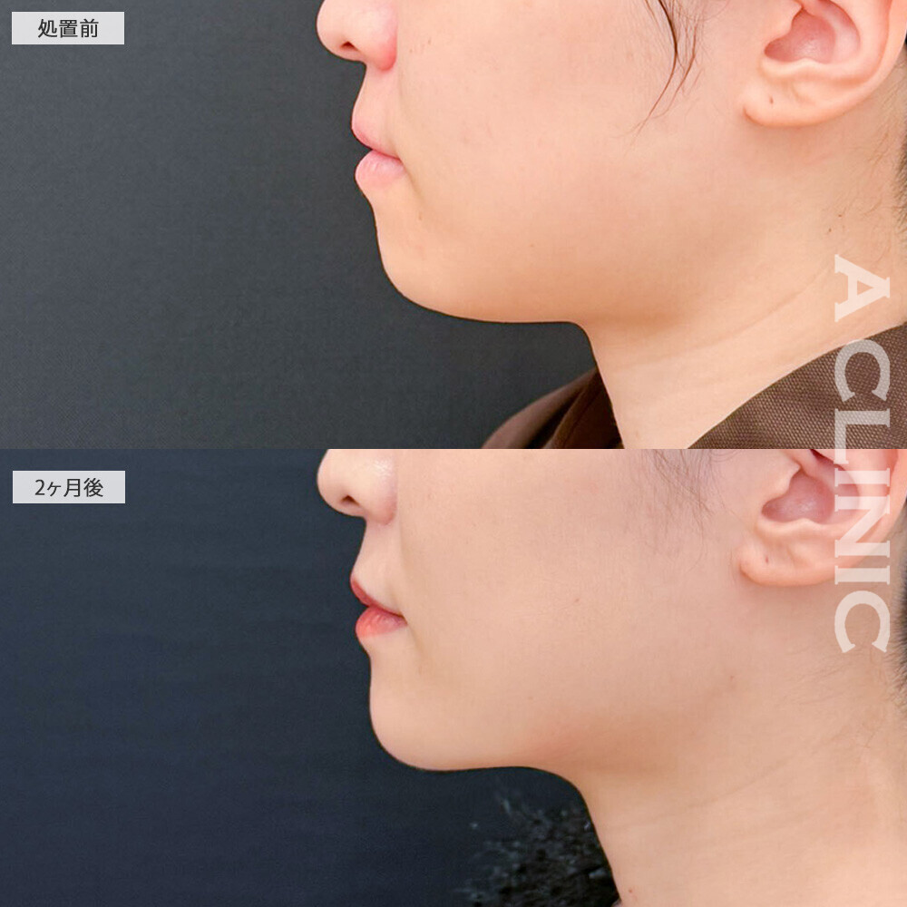 1day小顔脂肪吸引と小顔エラボトックスでどこから見てもしっかり小顔に！処置前と2ヶ月後の症例です(20代女性)