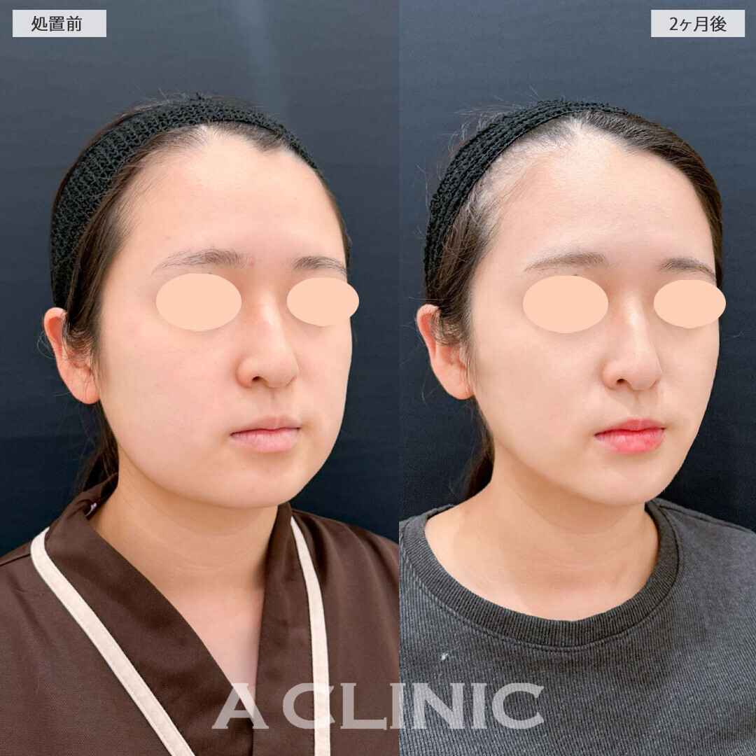 1day小顔脂肪吸引とバッカルファット除去術と小顔エラボトックスで頬のボリュームが激変！こちら処置前と2ヶ月後の症例です(20代女性)