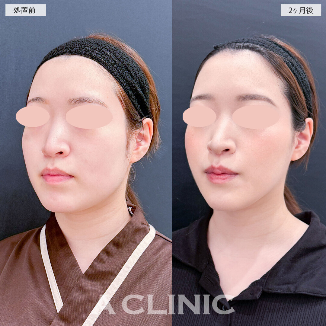 1day小顔脂肪吸引と小顔エラボトックスで女性らしい滑らかな輪郭に！処置前と2ヶ月後の症例です(20代女性)