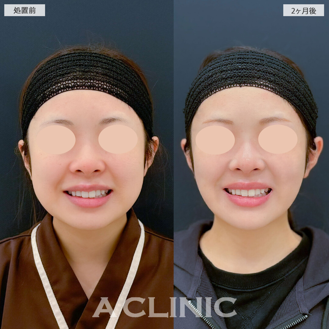 1day小顔脂肪吸引とバッカルファット除去術で気になる脂肪をしっかり除去しスッキリとしたフェイスラインになりました！こちら処置前と2ヶ月後の症例です(20代女性)