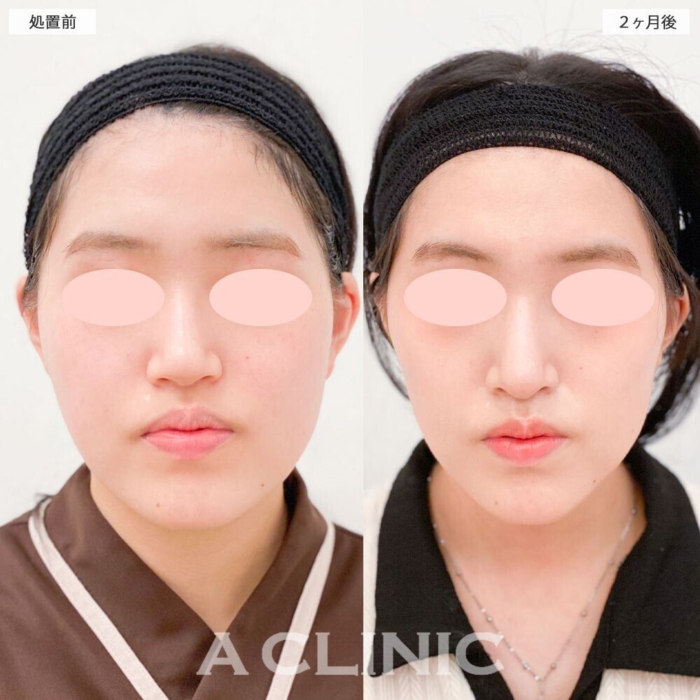 1day小顔脂肪吸引でシュッとしたVフェイスに！処置前と2ヵ月後の症例です(20代女性)