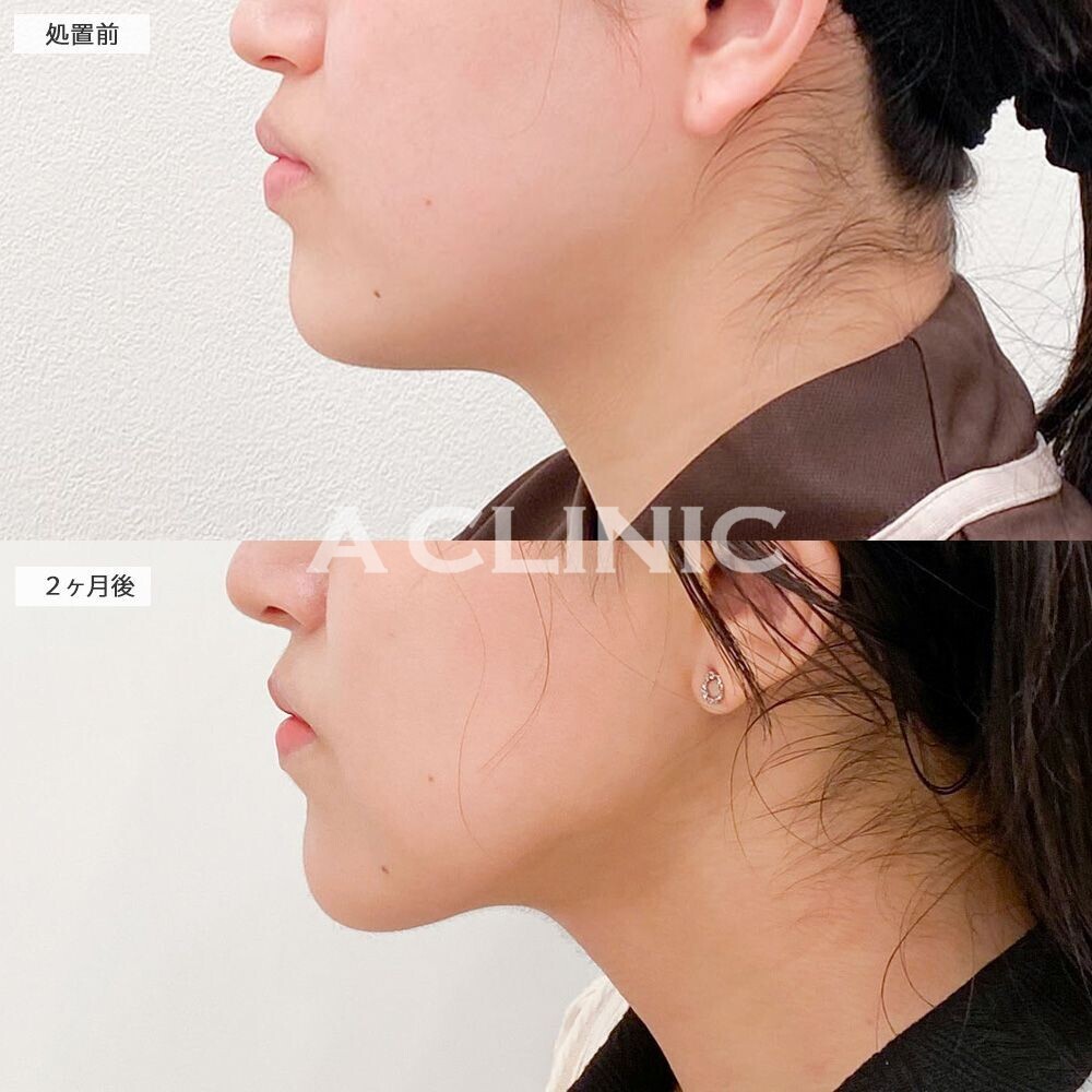 1day小顔脂肪吸引でシュッとしたVフェイスに！処置前と2ヵ月後の症例です(20代女性)
