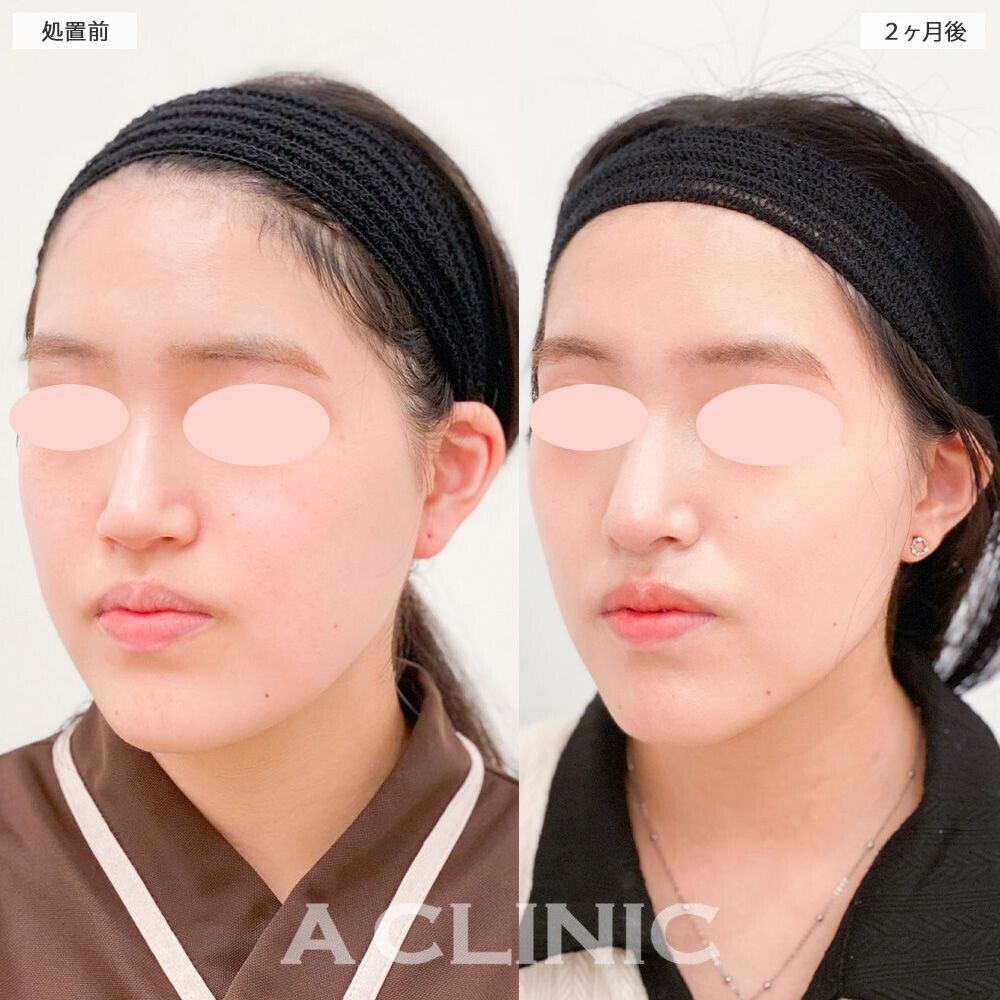 1day小顔脂肪吸引でシュッとしたVフェイスに！処置前と2ヵ月後の症例です(20代女性)