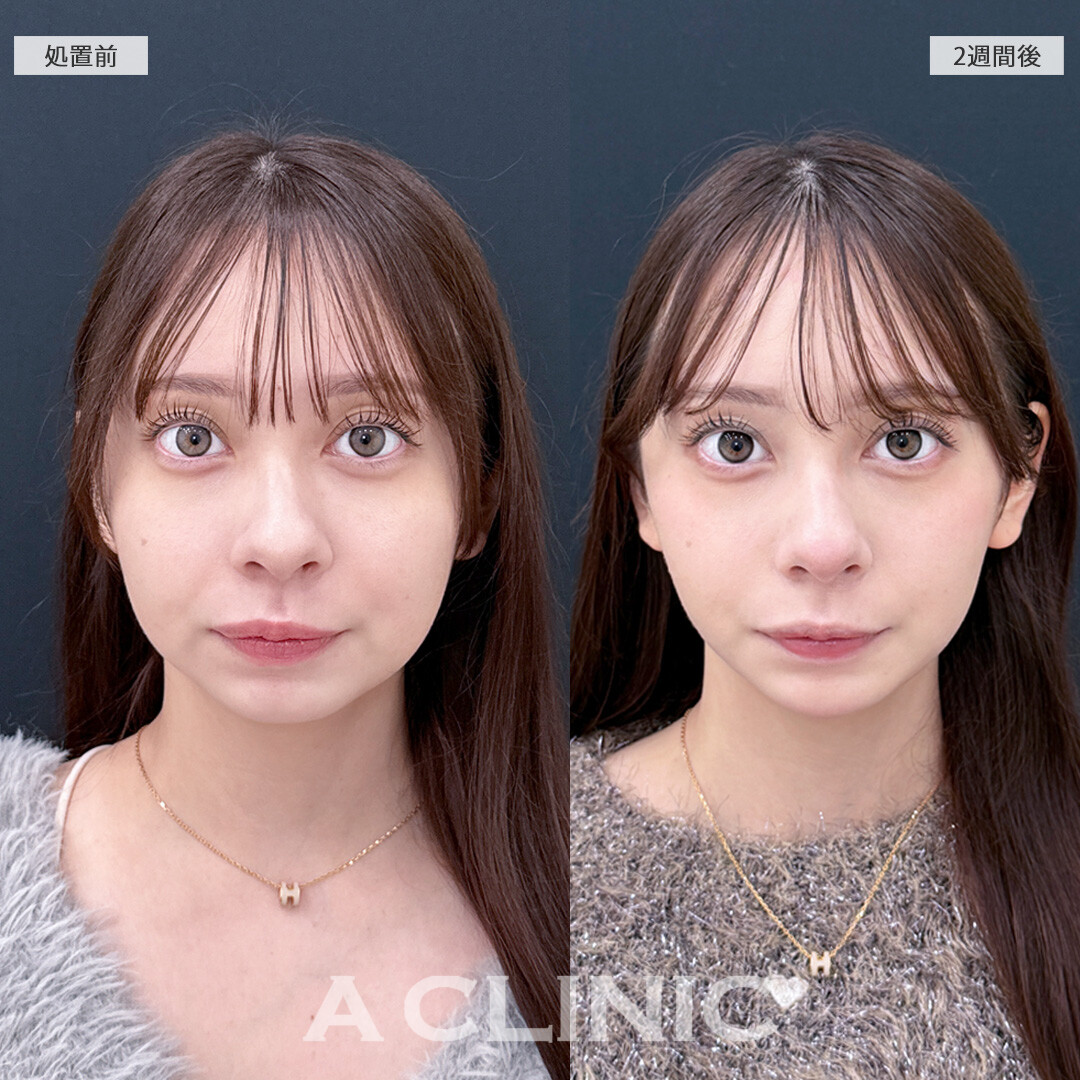 1day小顔脂肪吸引なら痩せても落ちないお顔の脂肪をピンポイントで撃退！こちら処置前と2週間後の症例です(10代女性)