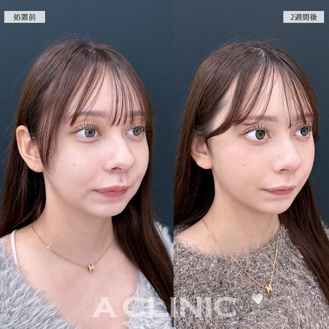 1day小顔脂肪吸引なら痩せても落ちないお顔の脂肪をピンポイントで撃退！こちら処置前と2週間後の症例です(10代女性)