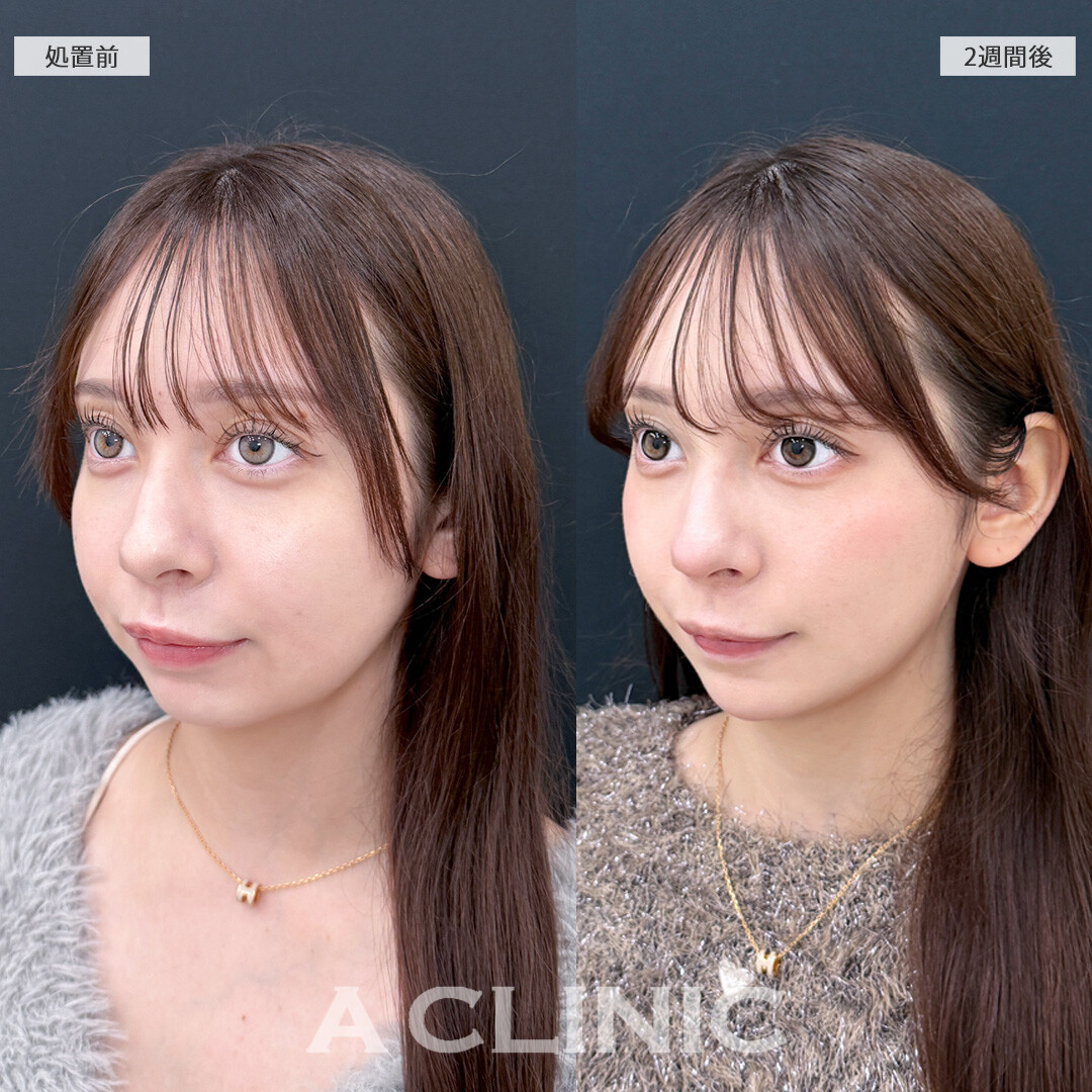 1day小顔脂肪吸引なら痩せても落ちないお顔の脂肪をピンポイントで撃退！こちら処置前と2週間後の症例です(10代女性)