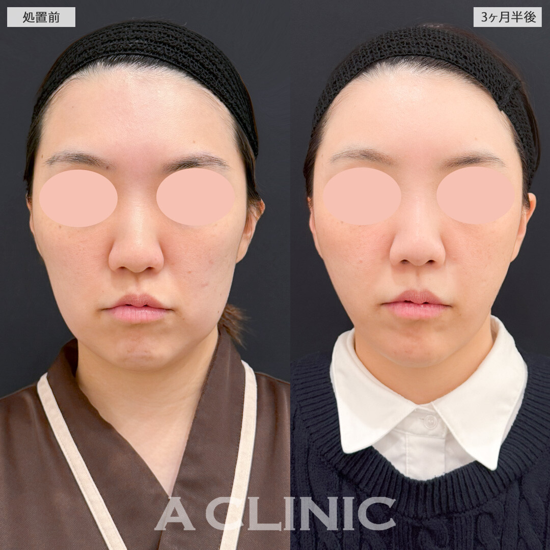 1day小顔脂肪吸引とナゾラビアルファット除去術でほうれい線や口横のたるみに悩まなくなりました！処置前と3ヶ月半後の症例です(30代女性)