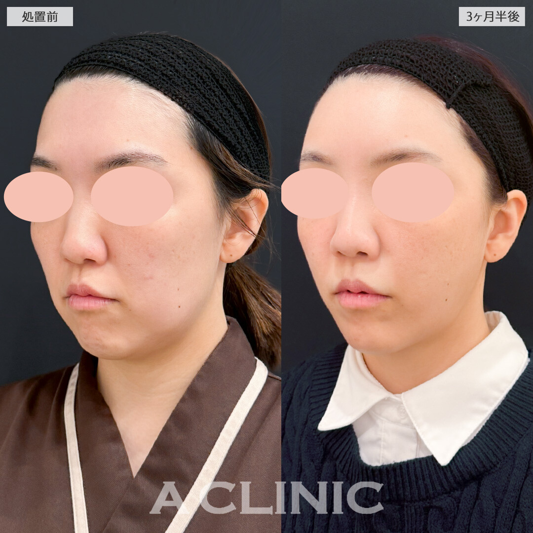 1day小顔脂肪吸引とナゾラビアルファット除去術でほうれい線や口横のたるみに悩まなくなりました！処置前と3ヶ月半後の症例です(30代女性)