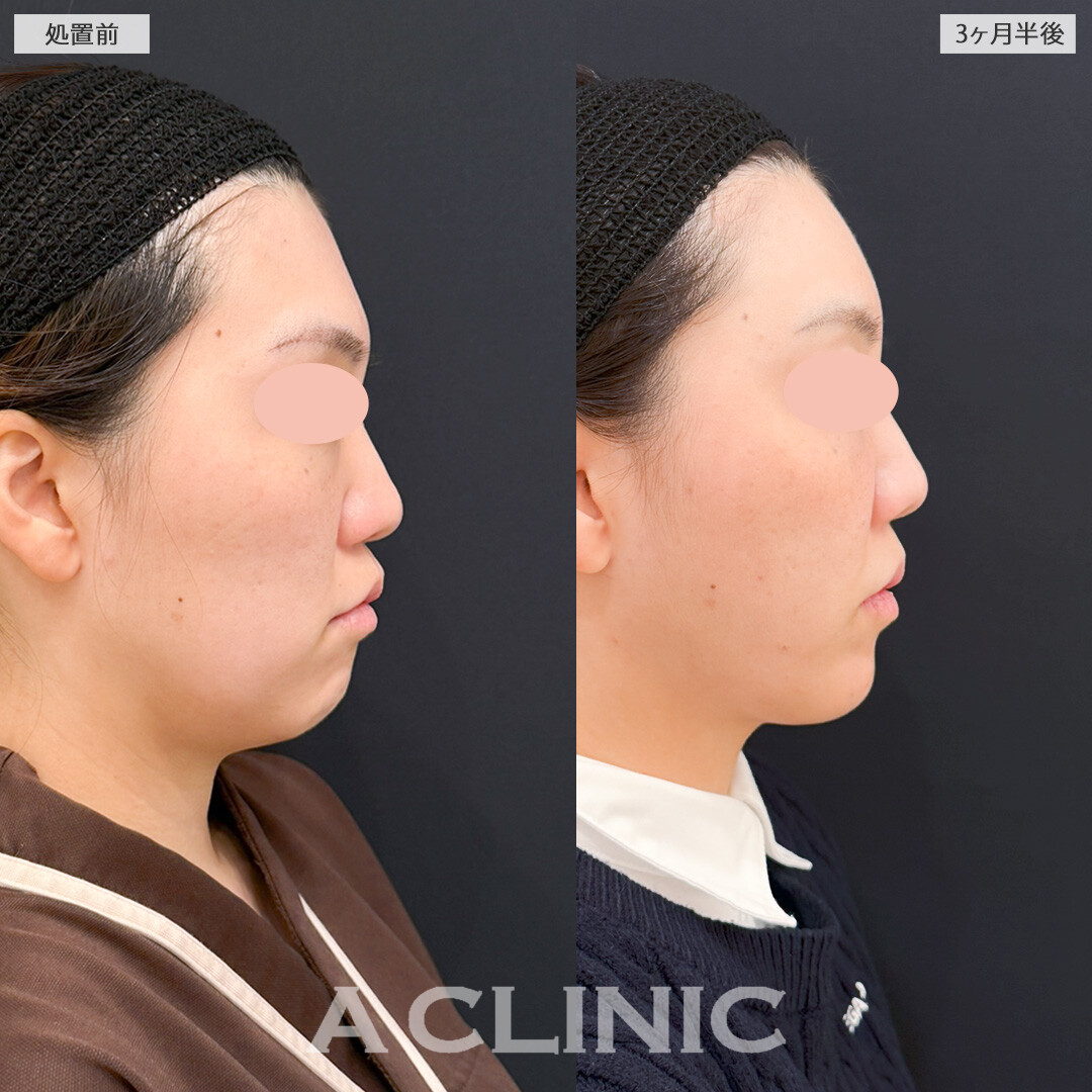 1day小顔脂肪吸引とナゾラビアルファット除去術でほうれい線や口横のたるみに悩まなくなりました！処置前と3ヶ月半後の症例です(30代女性)