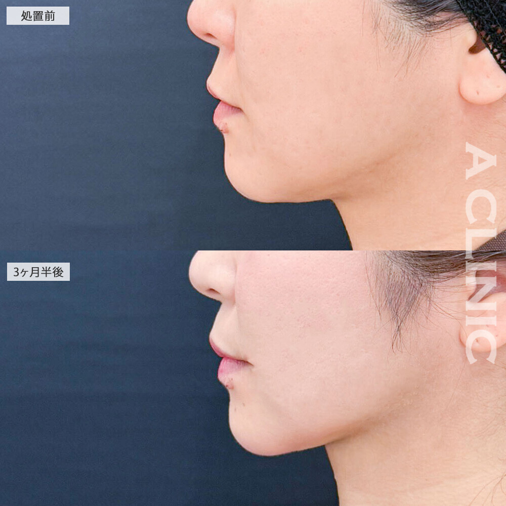 1day小顔脂肪吸引で横顔の印象がここまで変わる！こちら処置前から3ヶ月半後の症例です(40代女性)
