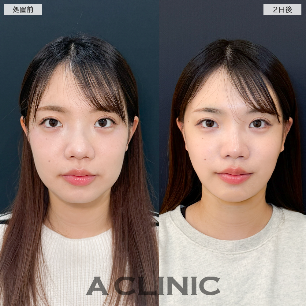 1day小顔脂肪吸引でダウンタイム少なくスッキリとした輪郭なりました！こちら処置前と2日後の症例です(20代女性)