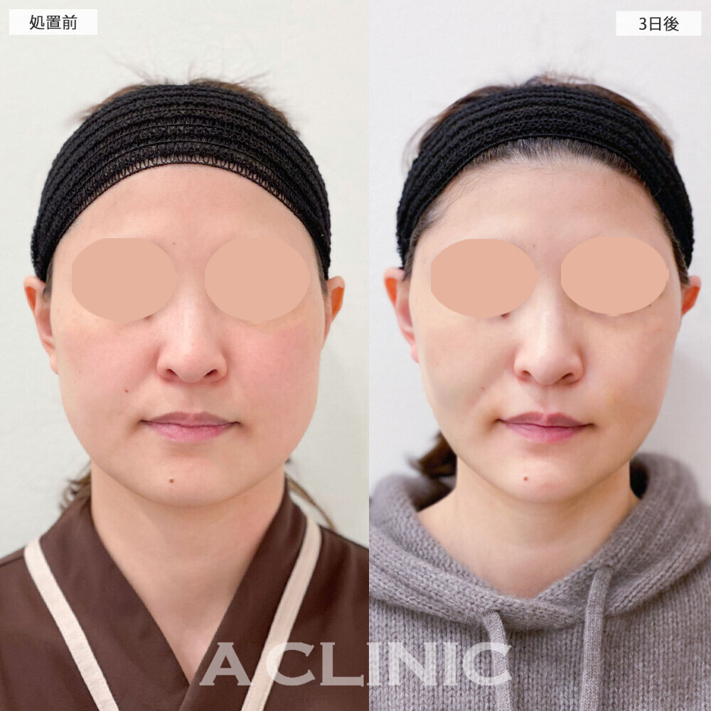 1day小顔脂肪吸引でお顔の丸さが改善！こちら処置前から3週間後の症例です(30代女性)