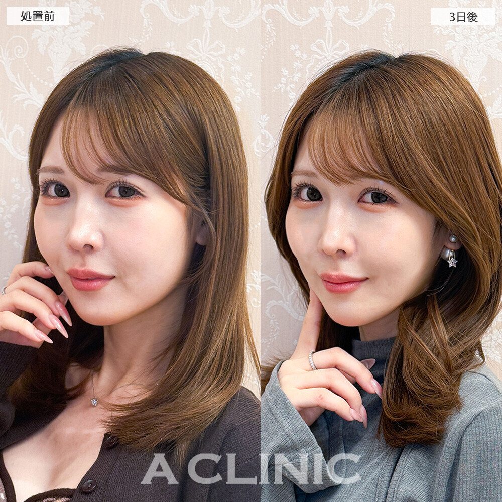 1day小顔脂肪吸引で頬のぷくっと感がなくなり卵型の輪郭に！こちら処置前から1ヶ月後の症例です(20代女性)