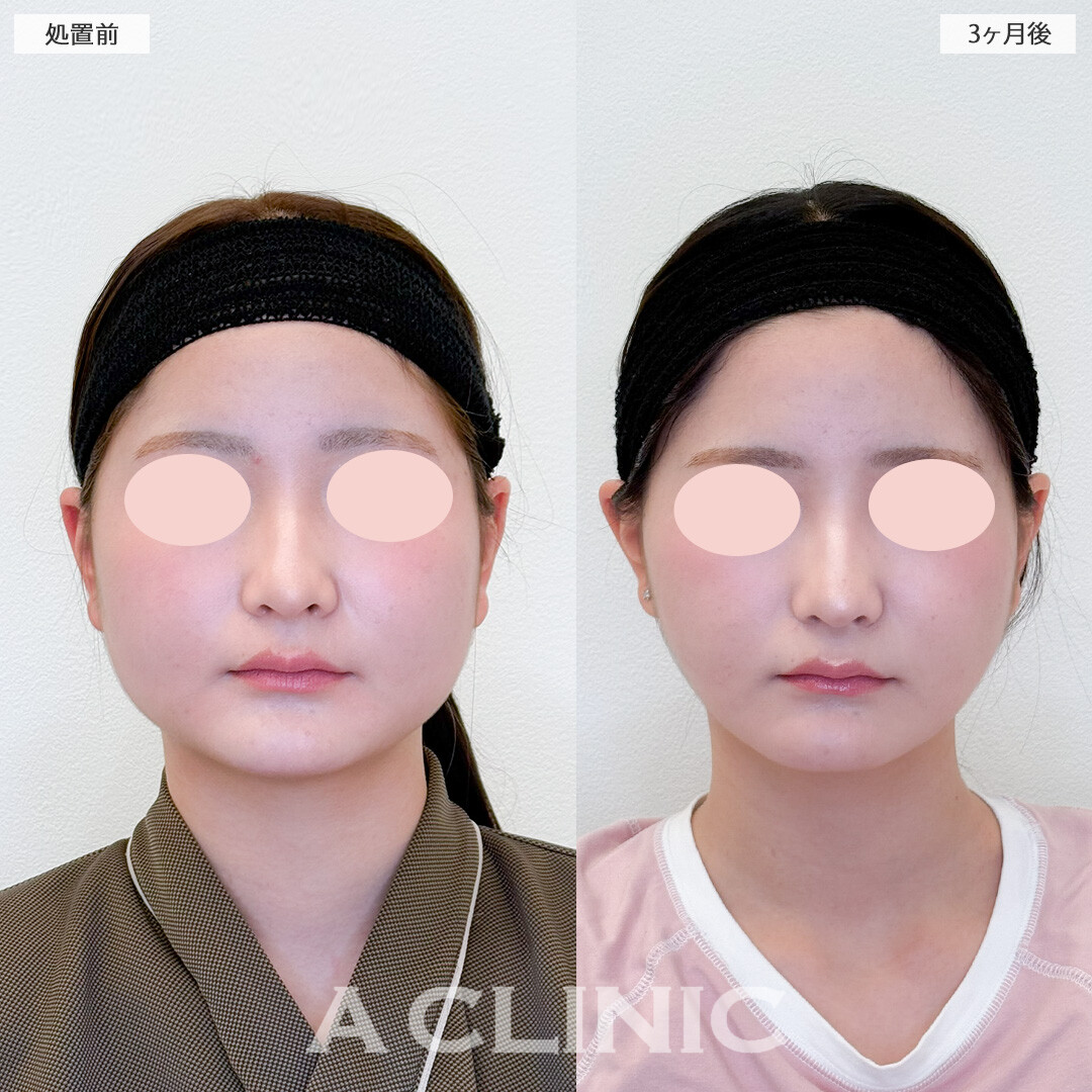 1day小顔脂肪吸引と小顔エラボトックスで丸顔卒業しどの角度から撮られても怖くない！処置前と3ヶ月後の症例です(10代女性)