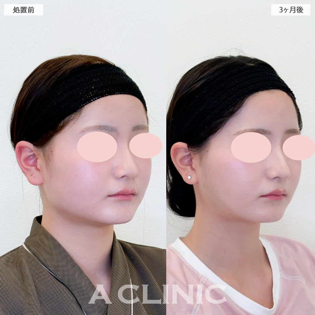 1day小顔脂肪吸引と小顔エラボトックスで丸顔卒業しどの角度から撮られても怖くない！処置前と3ヶ月後の症例です(10代女性)