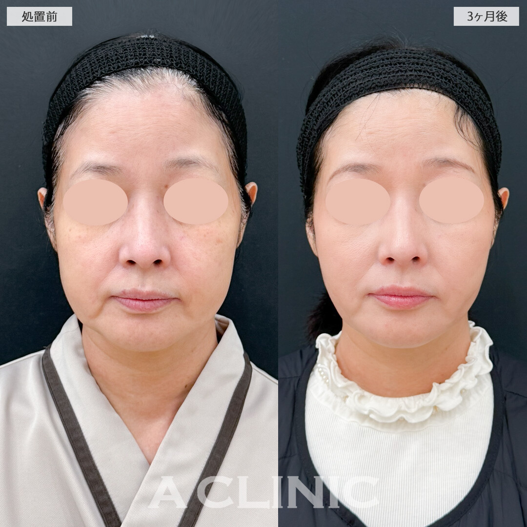 1day小顔脂肪吸引でもたつきがなくなると一気に若返ります！処置前と3ヶ月後の症例です(50代女性)