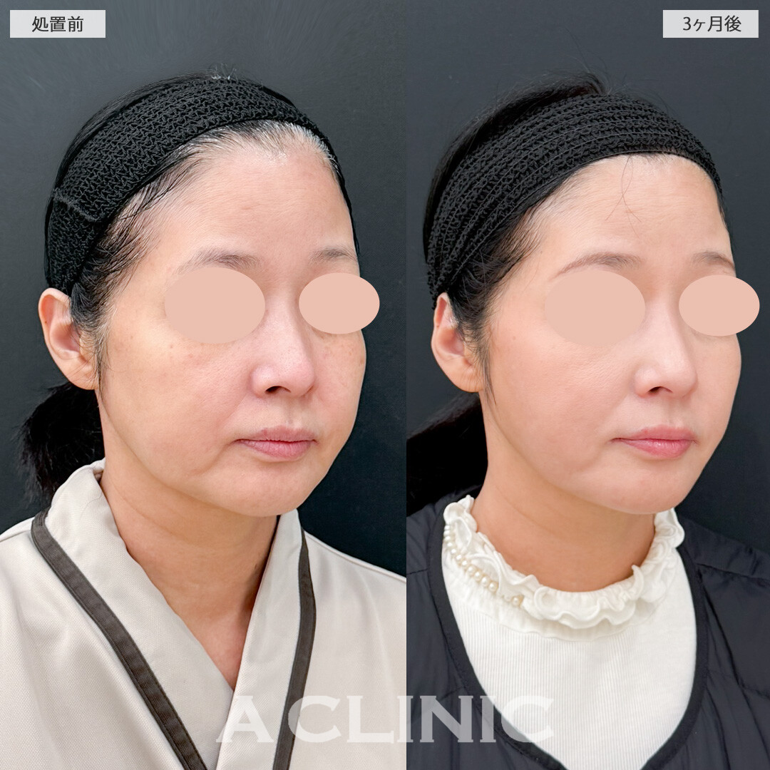 1day小顔脂肪吸引でもたつきがなくなると一気に若返ります！処置前と3ヶ月後の症例です(50代女性)