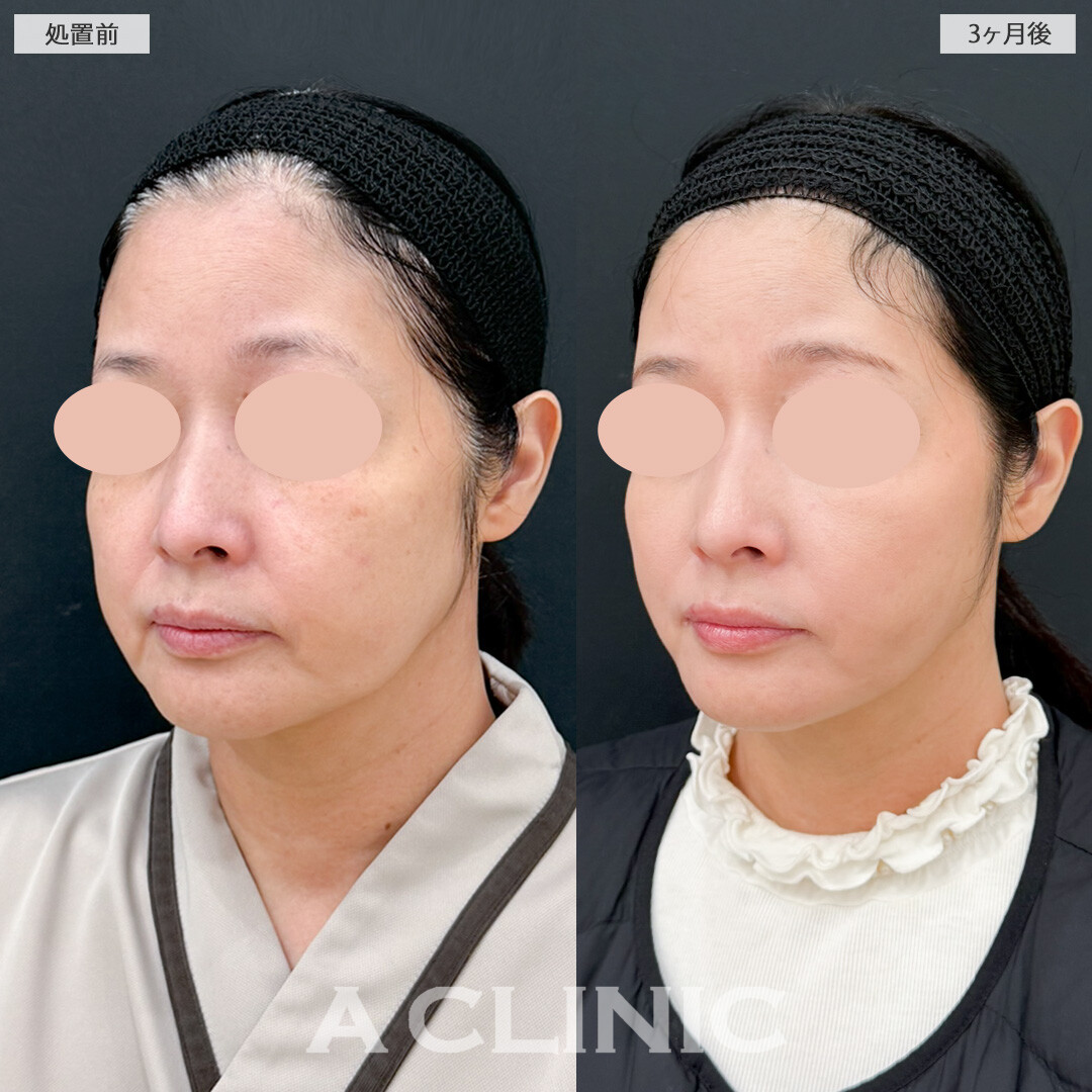 1day小顔脂肪吸引でもたつきがなくなると一気に若返ります！処置前と3ヶ月後の症例です(50代女性)