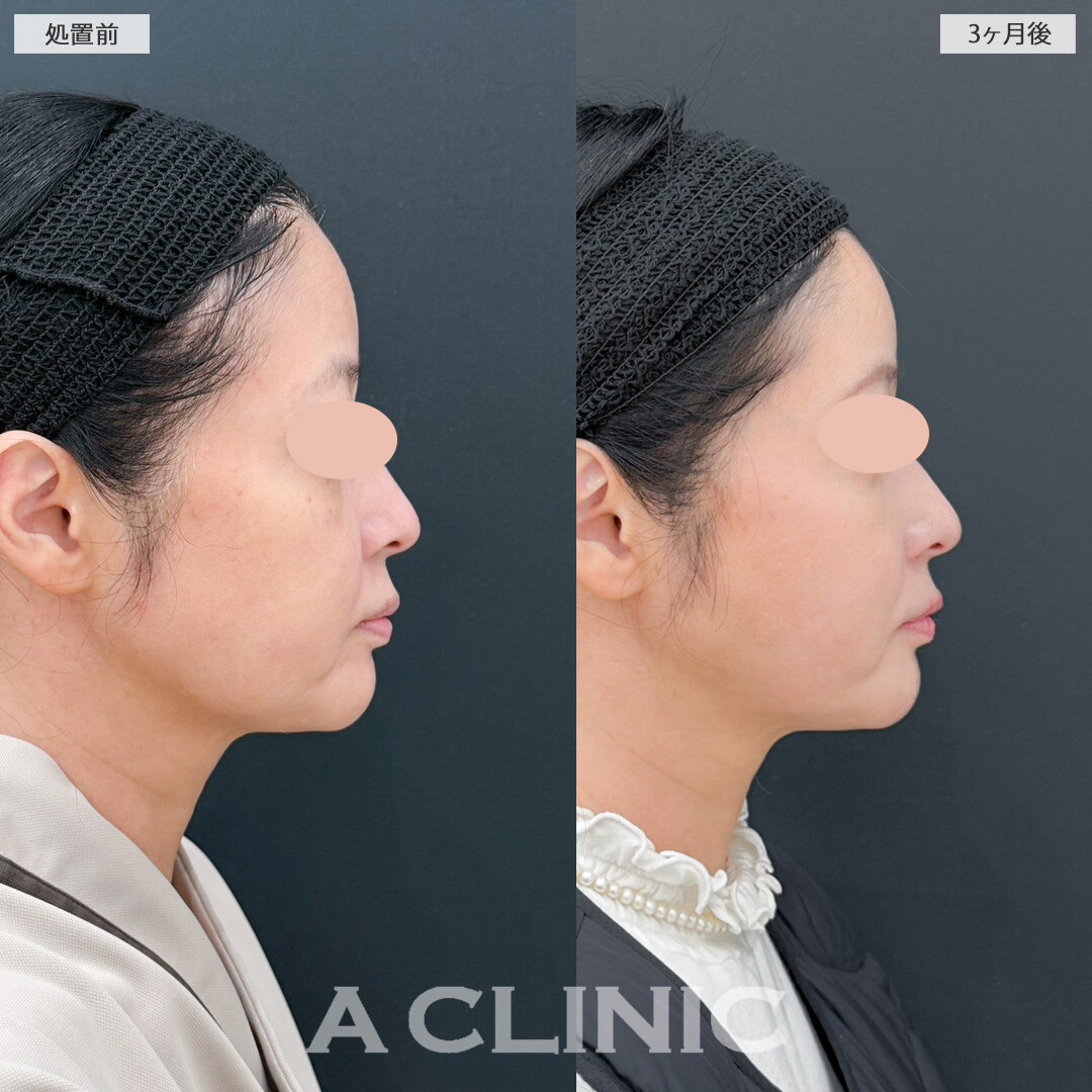 1day小顔脂肪吸引でもたつきがなくなると一気に若返ります！処置前と3ヶ月後の症例です(50代女性)