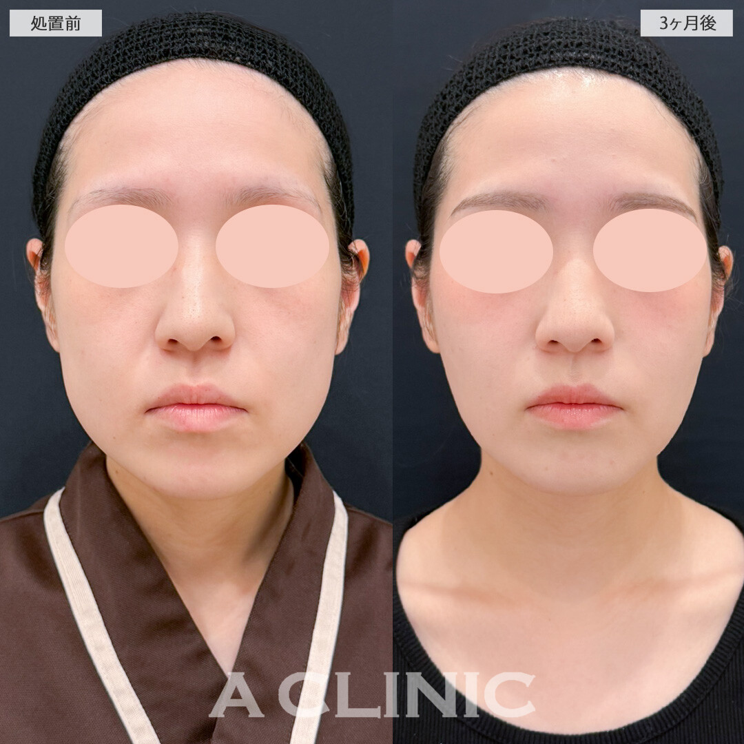 1day小顔脂肪吸引とバッカルファット除去術で笑った時のぼこつきが減り気にせず笑えるようになりました！処置前と3ヶ月後の症例です(20代女性)