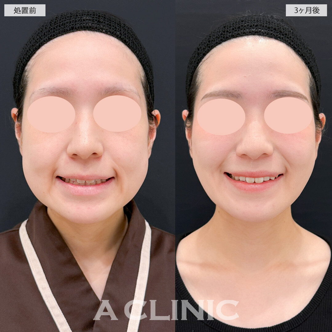 1day小顔脂肪吸引とバッカルファット除去術で笑った時のぼこつきが減り気にせず笑えるようになりました！処置前と3ヶ月後の症例です(20代女性)