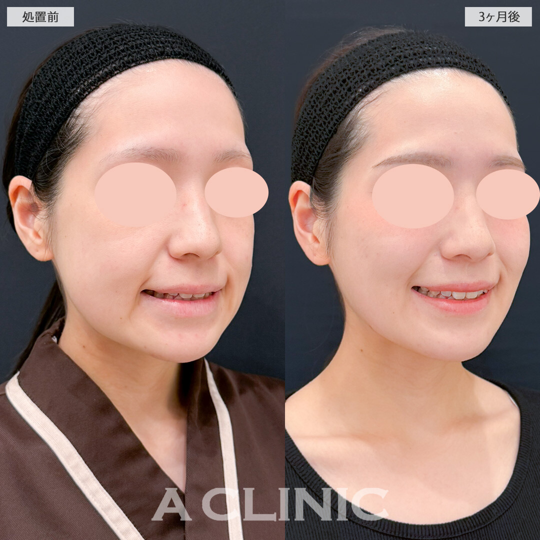 1day小顔脂肪吸引とバッカルファット除去術で笑った時のぼこつきが減り気にせず笑えるようになりました！処置前と3ヶ月後の症例です(20代女性)