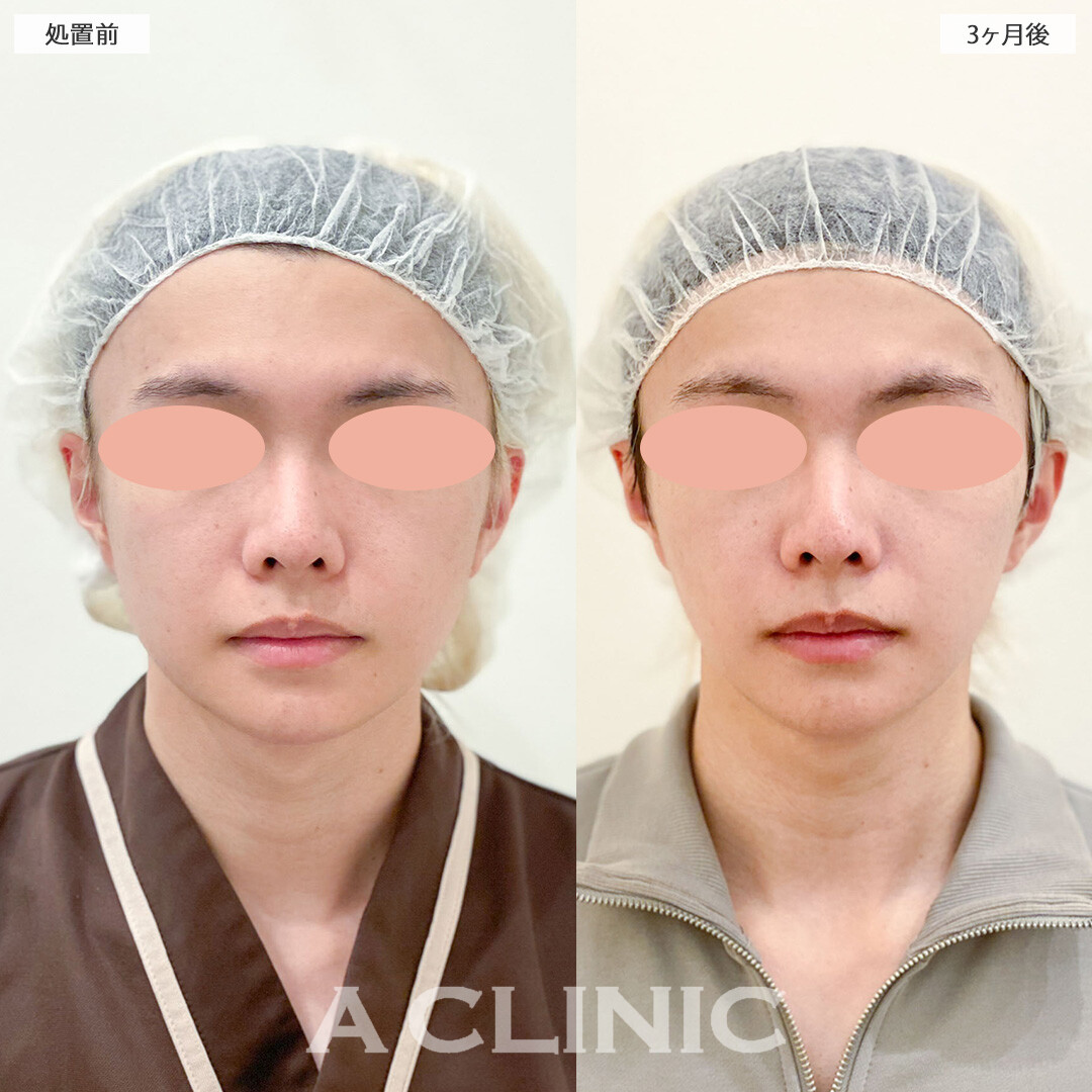 1day小顔脂肪吸引はメンズにも垢抜け美容として大人気！こちら処置前と3ヶ月後の症例です(20代男性)