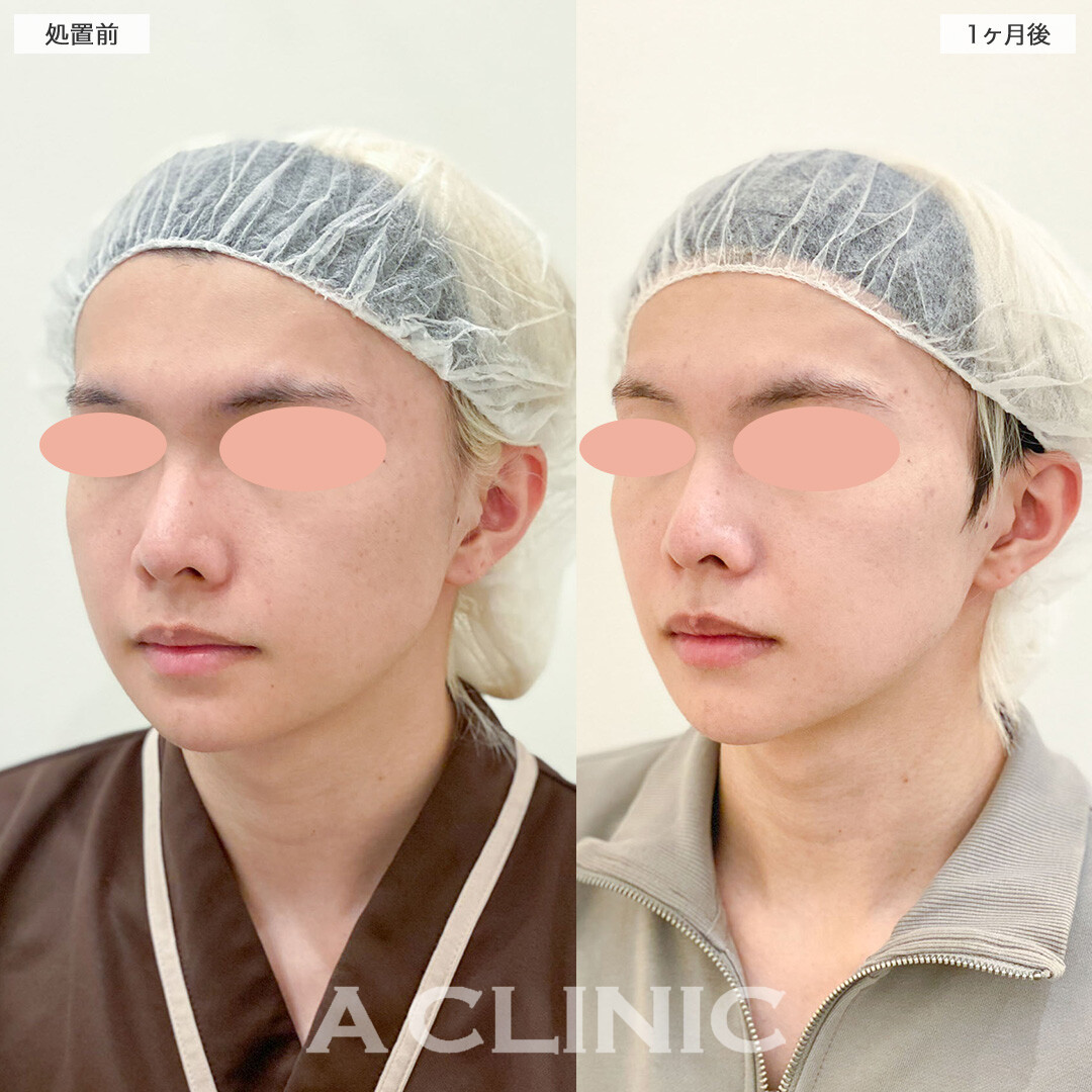 1day小顔脂肪吸引はメンズにも垢抜け美容として大人気！こちら処置前と3ヶ月後の症例です(20代男性)