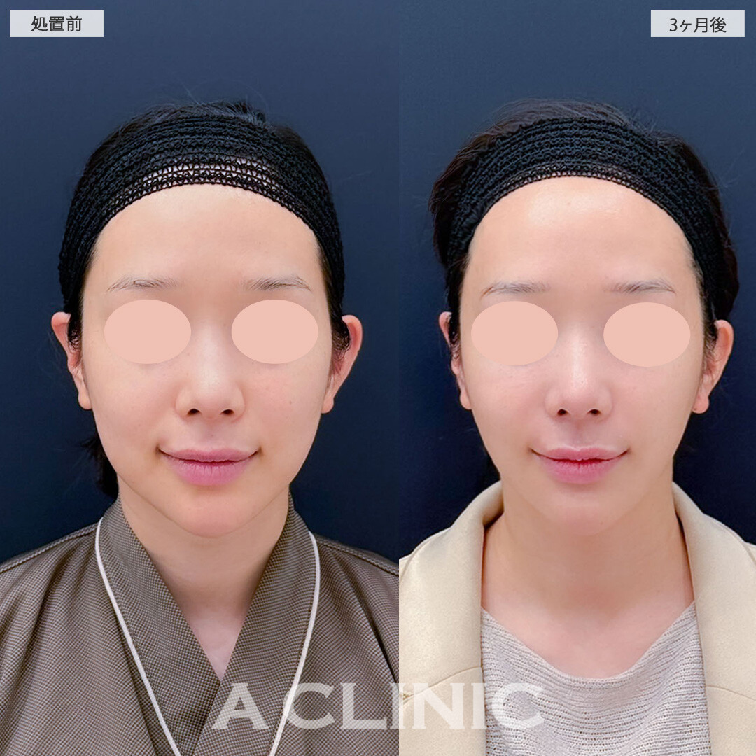 1day小顔脂肪吸引とバッカルファット除去術で口横のもたつきがなくなりスッキリとしたフェイスラインに！こちら処置前と3ヶ月後の症例です(30代女性)