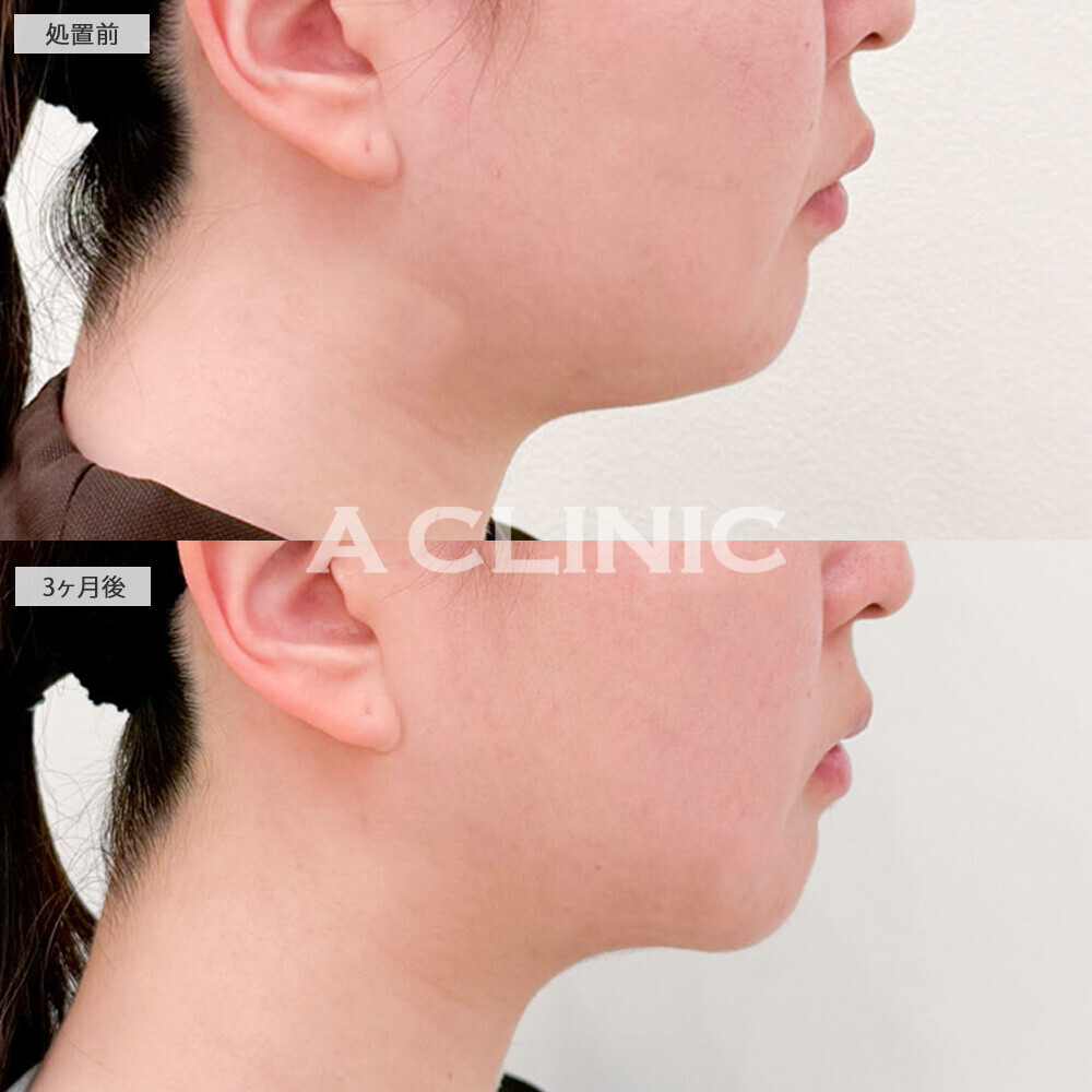 1day小顔脂肪吸引と小顔エラボトックスで理想通りの卵型フェイスに！処置前と3ヶ月後の症例です(20代女性)