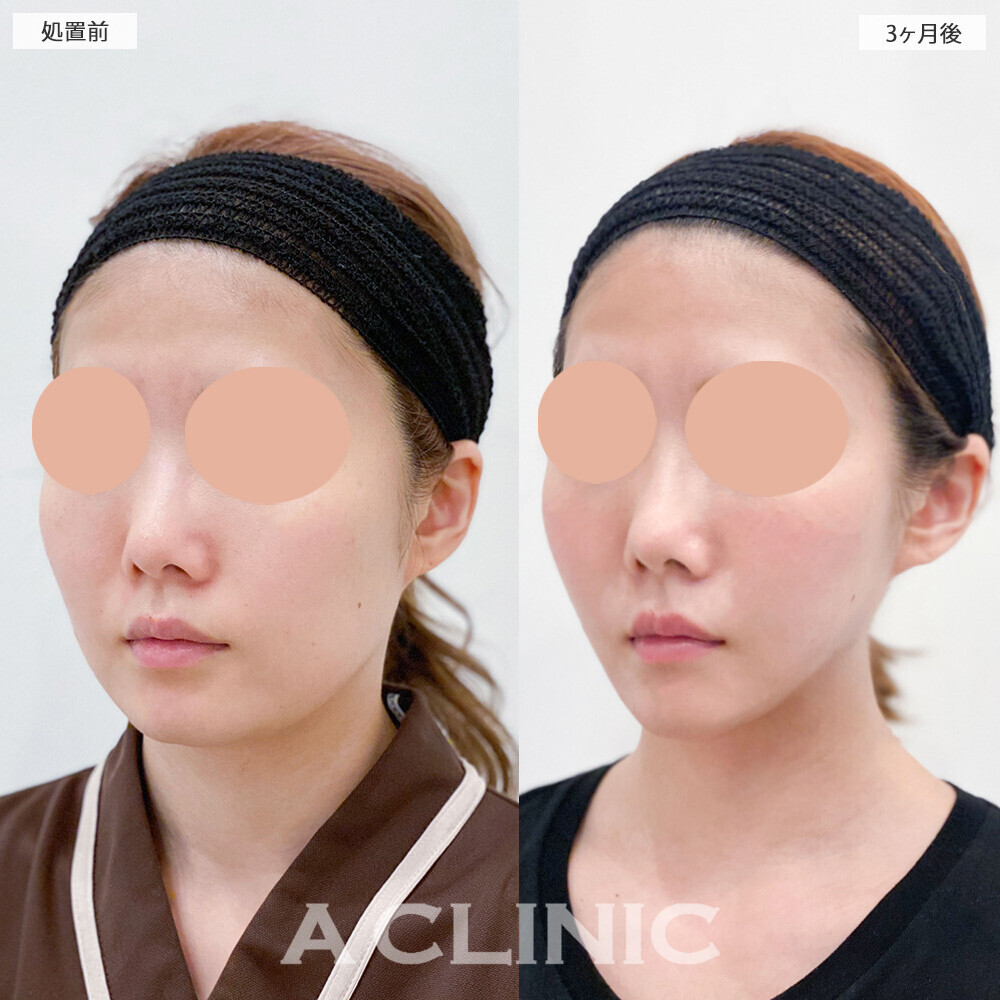 1day小顔脂肪吸引とあごへのヒアルロン酸注入で綺麗なVフェイスに！こちら処置前と3ヶ月後の症例です(30代女性)