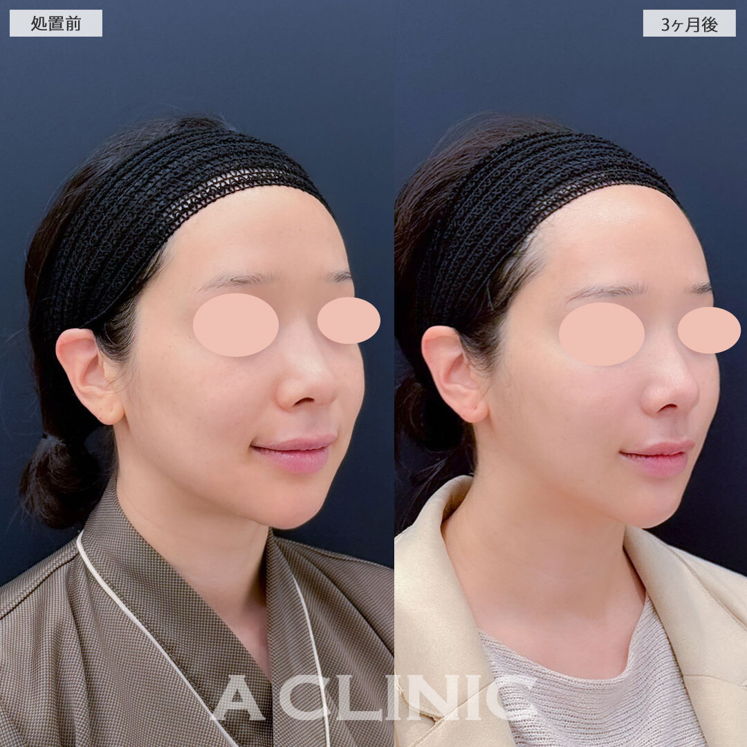 1day小顔脂肪吸引とバッカルファット除去術で口横のもたつきがなくなりスッキリとしたフェイスラインに！こちら処置前と3ヶ月後の症例です(30代女性)