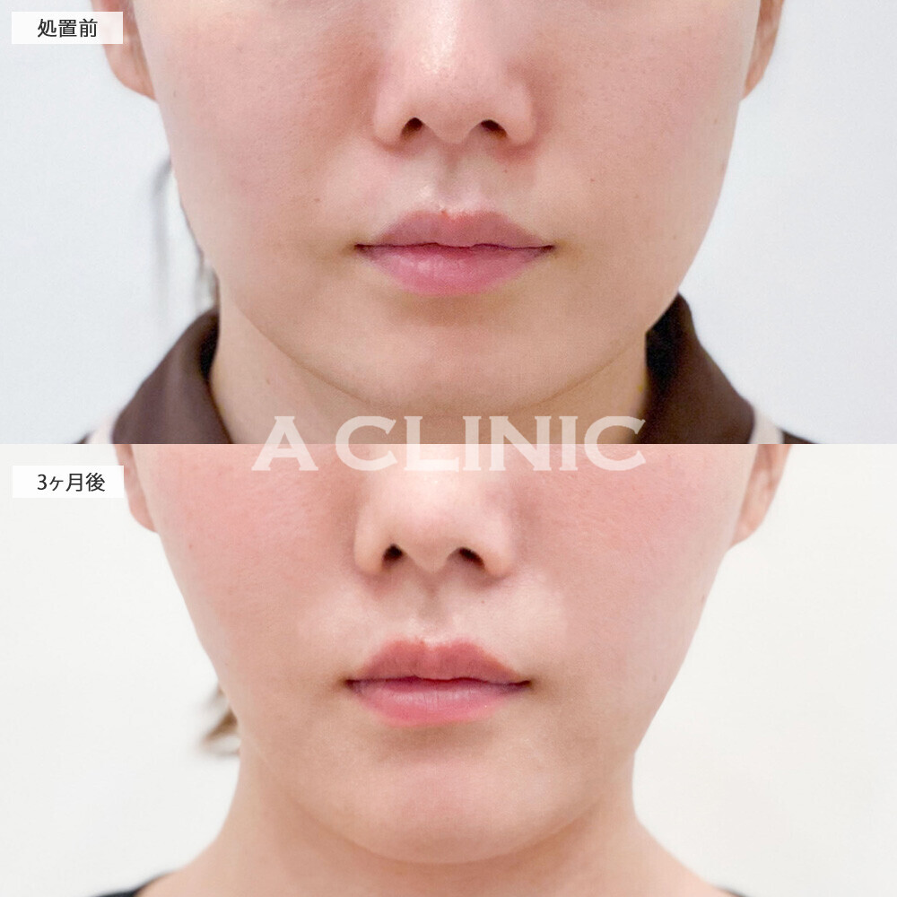 1day小顔脂肪吸引とあごへのヒアルロン酸注入で綺麗なVフェイスに！こちら処置前と3ヶ月後の症例です(30代女性)