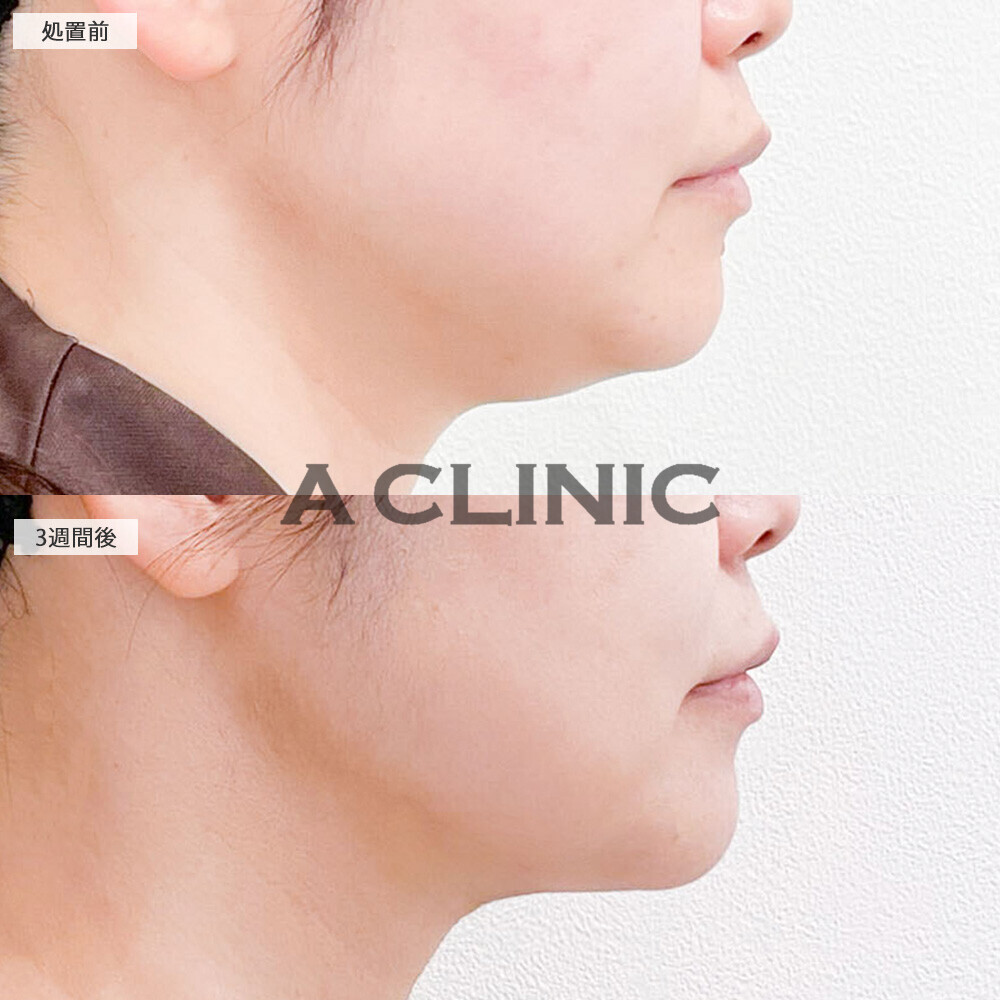 1day小顔脂肪吸引であご下のぷにぷにが無くなり引き締まった印象に！こちら処置前と3週間後の症例です(30代女性)