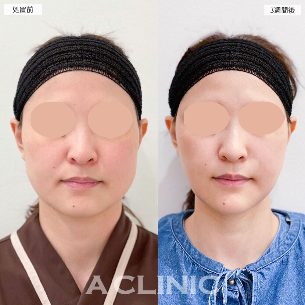 1day小顔脂肪吸引でお顔の丸さが改善！こちら処置前から3週間後の症例です(30代女性)