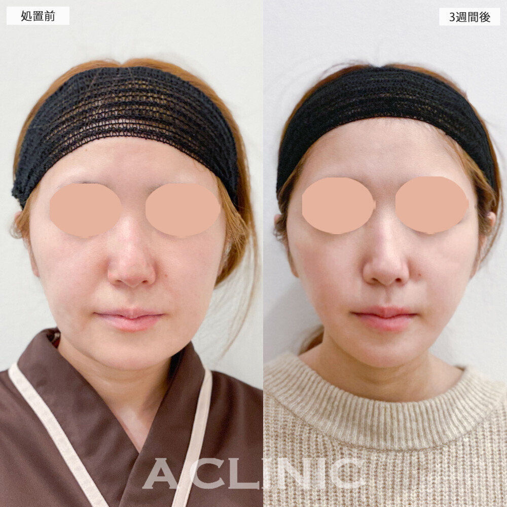 1day小顔脂肪吸引でお顔の左右差も綺麗に整いました！こちら処置前と3週間後の症例です(30代女性)