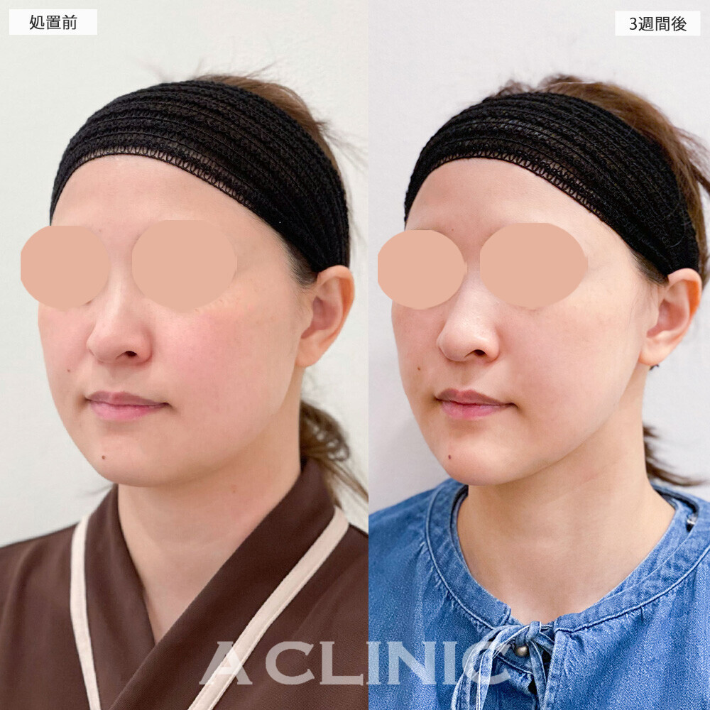 1day小顔脂肪吸引でお顔の丸さが改善！こちら処置前から3週間後の症例です(30代女性)