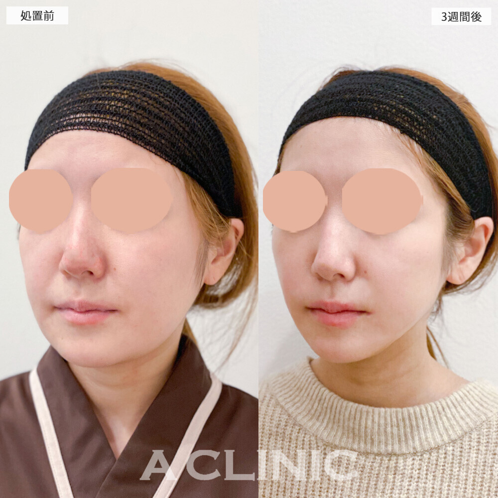 1day小顔脂肪吸引でお顔の左右差も綺麗に整いました！こちら処置前と3週間後の症例です(30代女性)