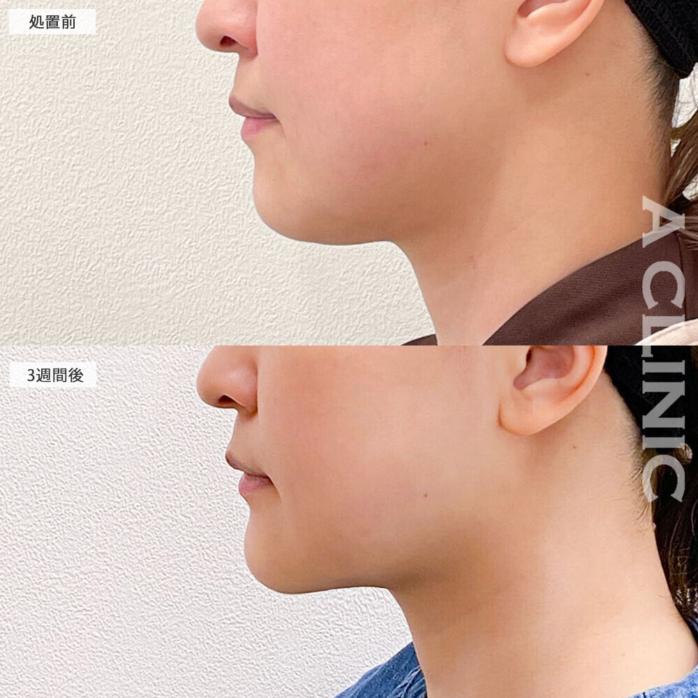 1day小顔脂肪吸引でお顔の丸さが改善！こちら処置前から3週間後の症例です(30代女性)