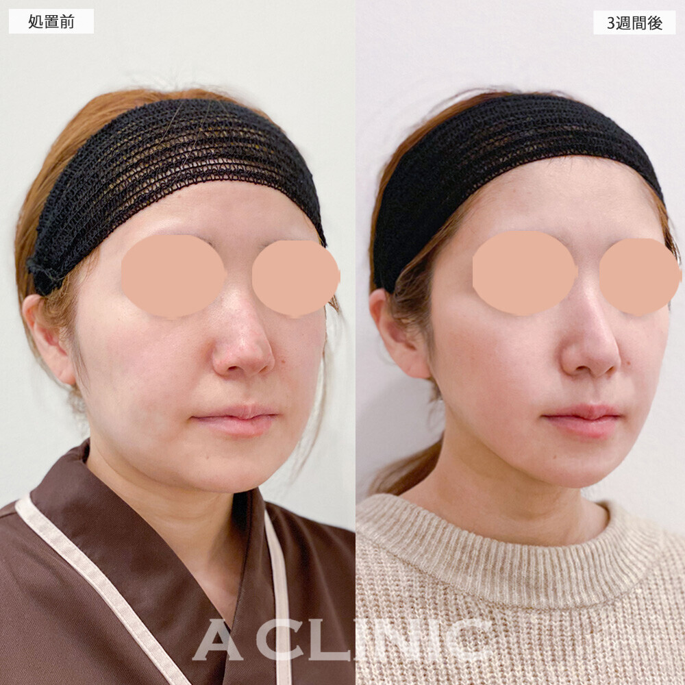 1day小顔脂肪吸引でお顔の左右差も綺麗に整いました！こちら処置前と3週間後の症例です(30代女性)