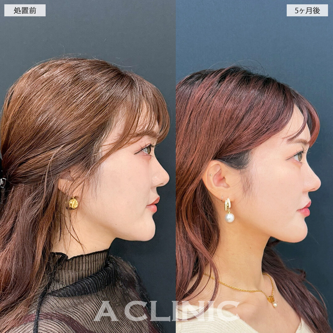 1day小顔脂肪吸引でアゴ下のもたつきがなくなり、フェイスラインがスッキリしました！処置前と5ヶ月後の症例です(20代女性)